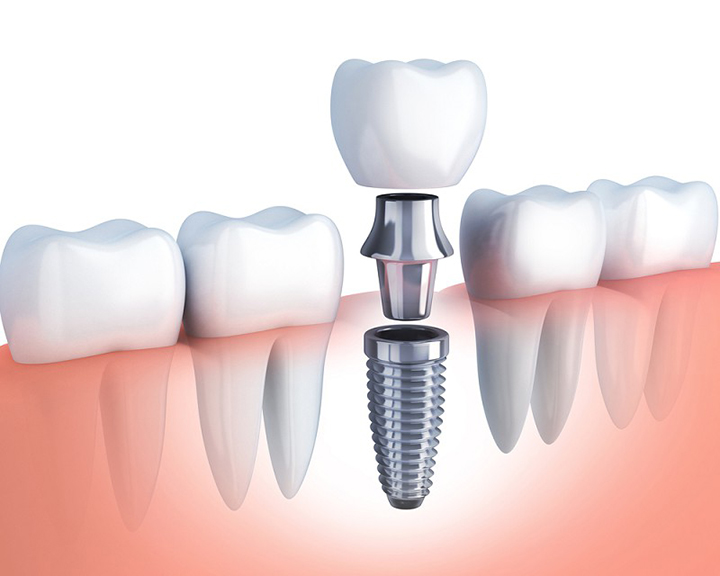 Trồng răng implant có phải là trồng răng thật không? - Nha Khoa Thúy Đức